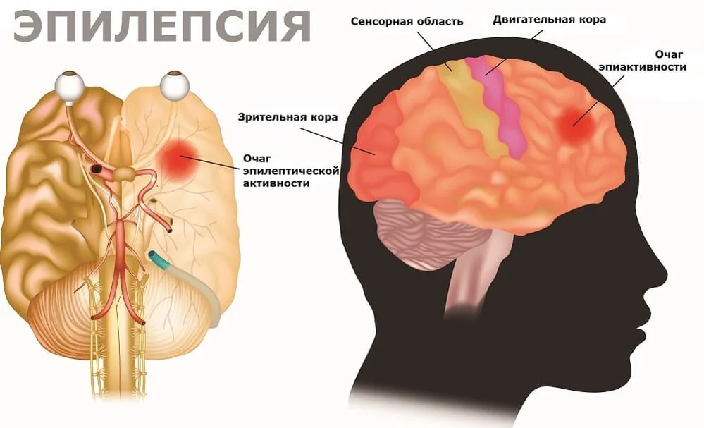 Эпилепсия